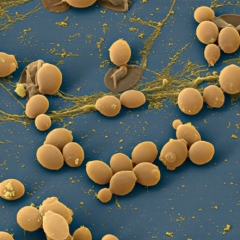 CANDIDIASIS CANDIDIASIS