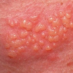 LAS 12 CLAVES DEL HERPES GENITAL.