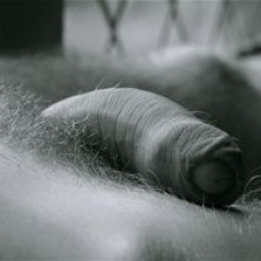 Tengo una curvatura en el pene cuando está erecto. ¿Se puede corregir? Tengo una curvatura en el pene cuando está erecto. ¿Se puede corregir?