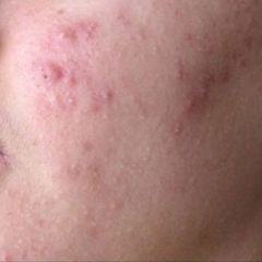 ¿La masturbación provoca espinillas?