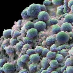 CÁNCER DE PRÓSTATA