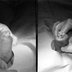 ¿Es cierto que todos los hombres necesitan la circuncisión?