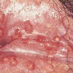 HERPES GENITAL
