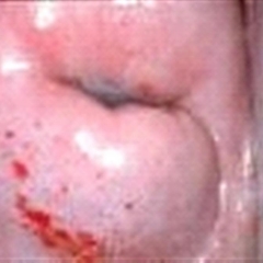 Me diagnosticaron el papiloma. ¿Eso significa que voy a tener cáncer?