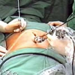 LAPAROSCOPIA LAPAROSCOPIA