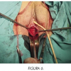 HISTERECTOMIA VAGINAL HISTERECTOMIA VAGINAL