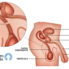¿Se puede revertir la vasectomía?