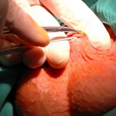 ESTERILIZACION MASCULINA ESTERILIZACION MASCULINA