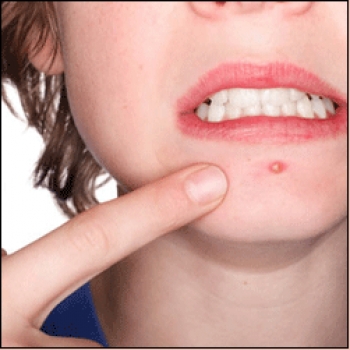 Tengo muchas espinillas. ¿Es producto de  la masturbación?