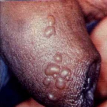 HERPES GENITAL