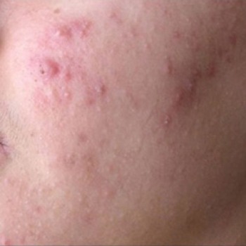 Tengo cuarenta años y me apareció un brote de espinillas. ¿Por qué a esta edad? Tengo cuarenta años y me apareció un brote de espinillas. ¿Por qué a esta edad?