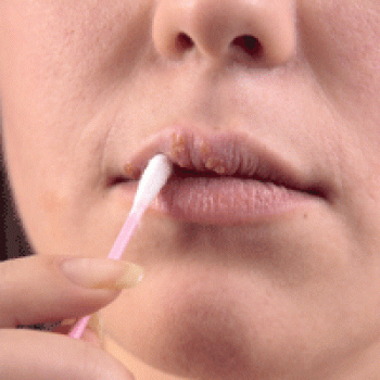 ¿Con el sexo oral se puede pasar a los genitales el herpes o fuego en la boca?