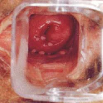 VIRUS DEL PAPILOMA HUMANO 